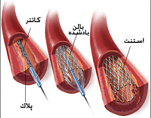 آنژِیوگرافی قلب 