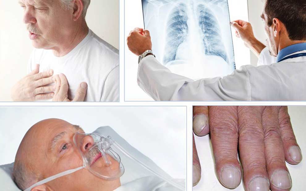 آمبولی ریه چیست و چگونه درمان میشود