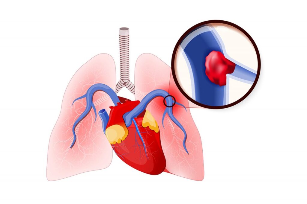 آمبولی ریه چیست و چگونه درمان میشود