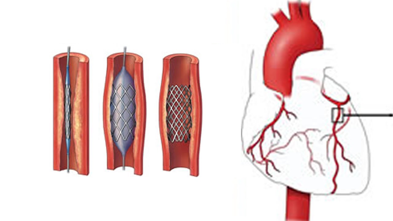 آنژیوپلاستی برای رفع گرفتگی عروق کرونر - درمان سکته قلبی
