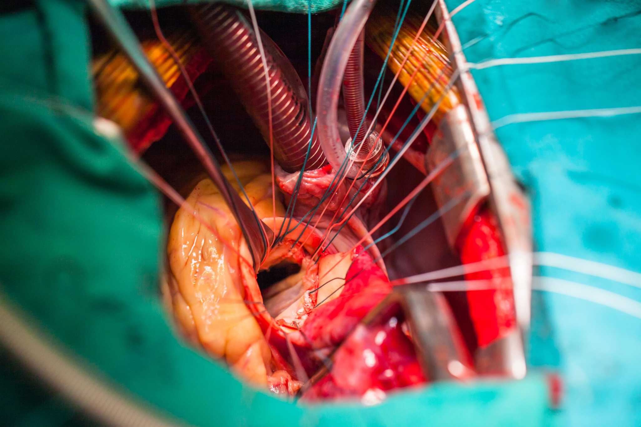 جراحی درمان نارسایی دریچه میترال