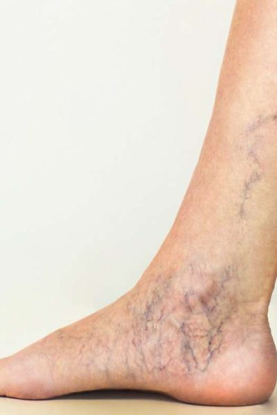 Photo of varicose veins of the ankle